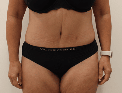 Tummy Tuck before and after - after