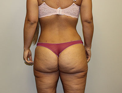 Liposuction before and after - after