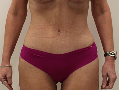 Tummy Tuck before and after - after