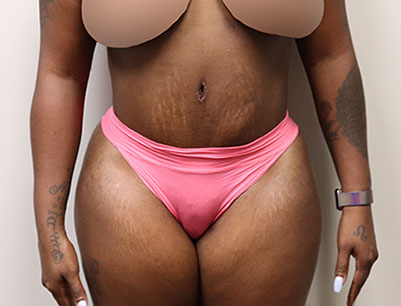 Tummy Tuck before and after - after