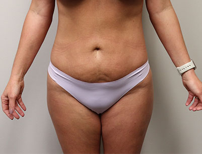 Liposuction before and after - after