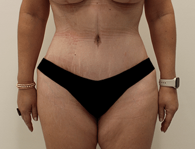 Tummy Tuck before and after - after