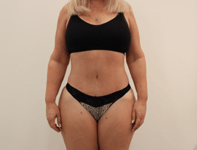 Liposuction before and after - after