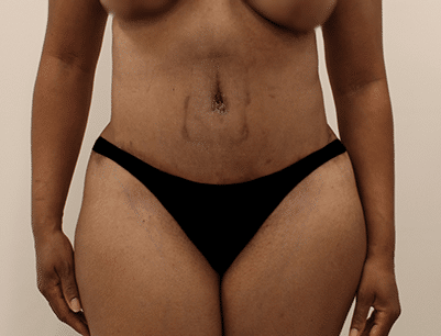 Tummy Tuck before and after - after