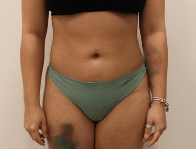 Liposuction before and after - after