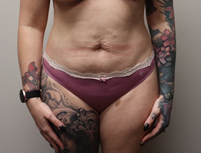 Liposuction before and after - after