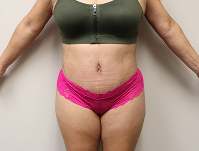 Tummy Tuck before and after - after