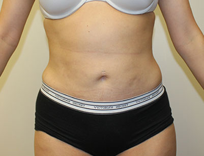 Liposuction before and after - after
