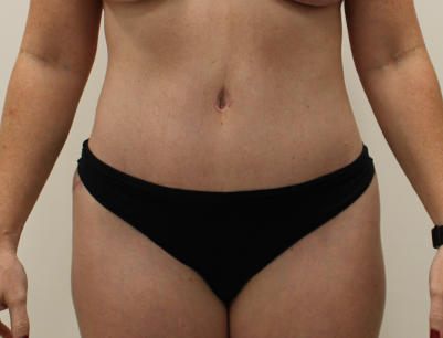 Tummy Tuck before and after - after