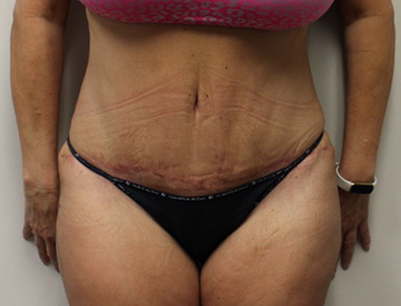Tummy Tuck before and after - after
