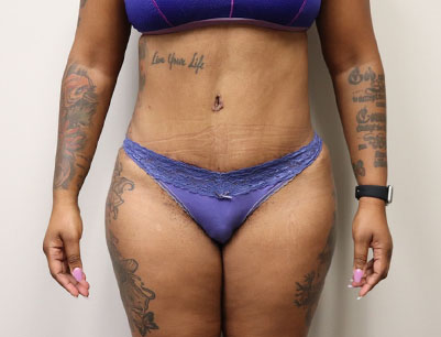 Tummy Tuck before and after - after