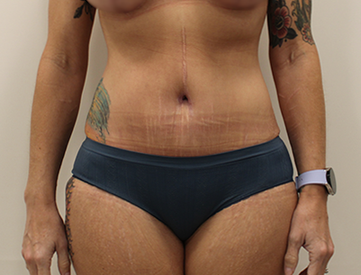 Tummy Tuck before and after - after
