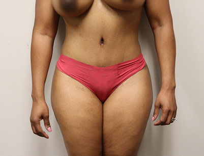 Tummy Tuck before and after - after