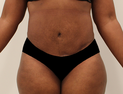 Liposuction before and after - after
