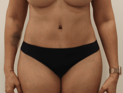 Tummy Tuck before and after - after