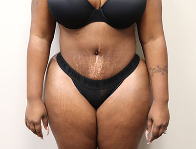 Tummy Tuck before and after - after