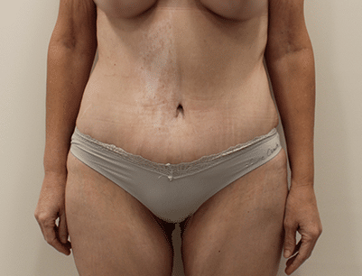 Tummy Tuck before and after - after