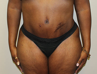 Tummy Tuck before and after - after