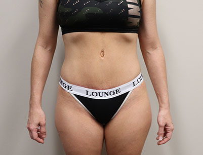 Tummy Tuck before and after - after