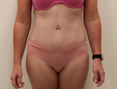 Tummy Tuck before and after - after