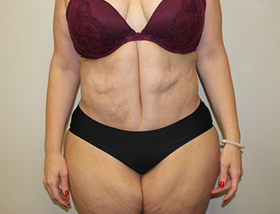 Tummy Tuck before and after - after
