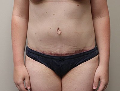 Tummy Tuck before and after - after