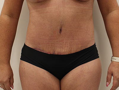 Tummy Tuck before and after - after