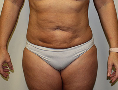 Liposuction before and after - after