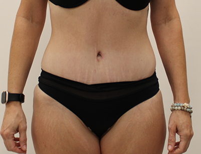 Tummy Tuck before and after - after