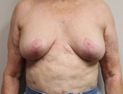 Breast Reduction before and after - after