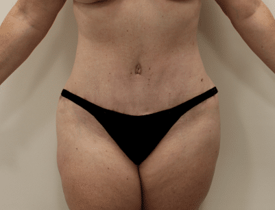 Tummy Tuck before and after - after