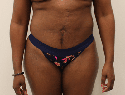 Liposuction before and after - after