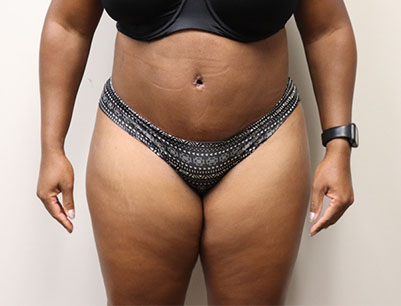 Tummy Tuck before and after - after