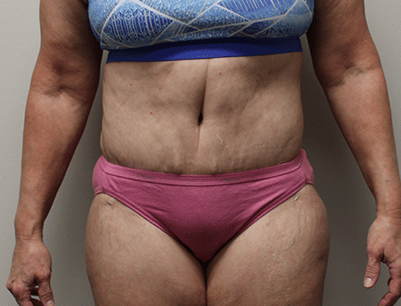 Tummy Tuck before and after - after