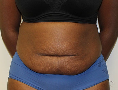 Tummy Tuck before and after - after