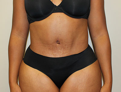 Tummy Tuck before and after - after