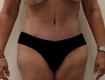 Tummy Tuck before and after - after