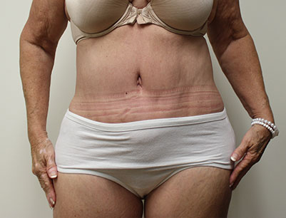 Tummy Tuck before and after - after