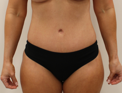 Tummy Tuck before and after - after