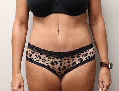 Tummy Tuck before and after - after