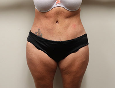 Tummy Tuck before and after - after