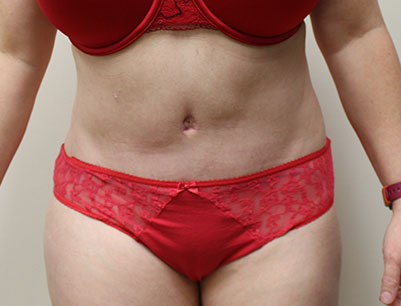 Tummy Tuck before and after - after
