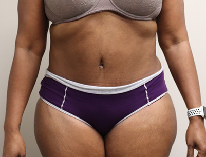 Tummy Tuck before and after - after