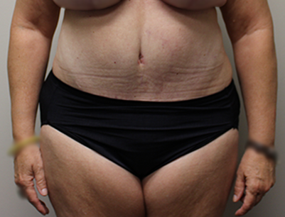 Tummy Tuck before and after - after
