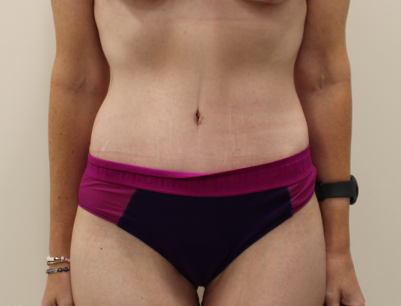 Tummy Tuck before and after - after