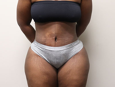 Tummy Tuck before and after - after