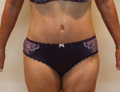 Tummy Tuck before and after - after
