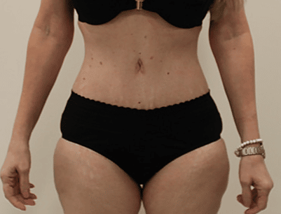 Tummy Tuck before and after - after
