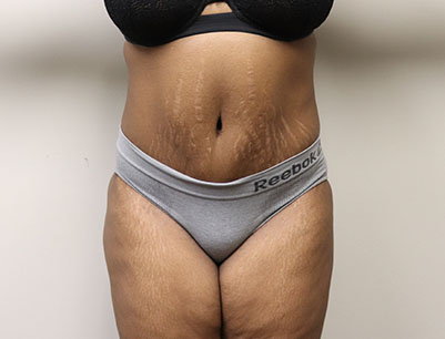 Tummy Tuck before and after - after
