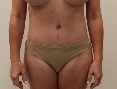 Tummy Tuck before and after - after